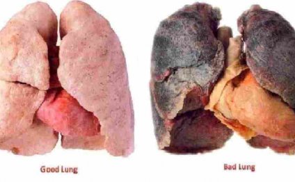 Tobacco And Lung Cancer