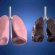 Lung cancer due to smoking