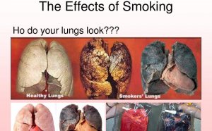 Cigarette smoking causes