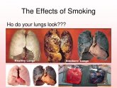 Cigarette smoking causes