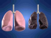 Lung cancer due to smoking