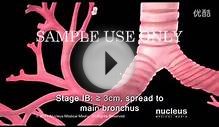 Lung_Cancer_Staging_Non-small_Cell