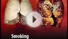 oral cancer, tobacco and smoking