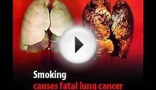 Smoking Lung Cancer.wmv